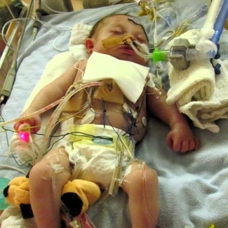 Infant in diaper on hospital bed connected to tubes